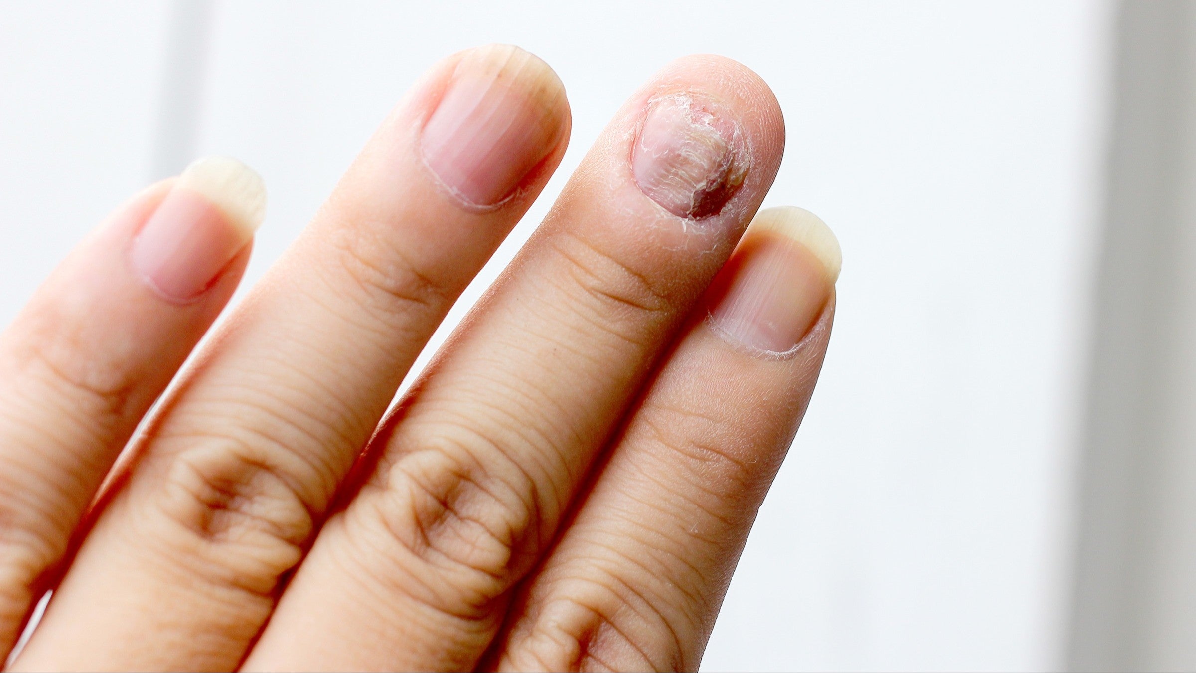 Antibiotics for Nail Infection: When You Need Them & What Comes Next